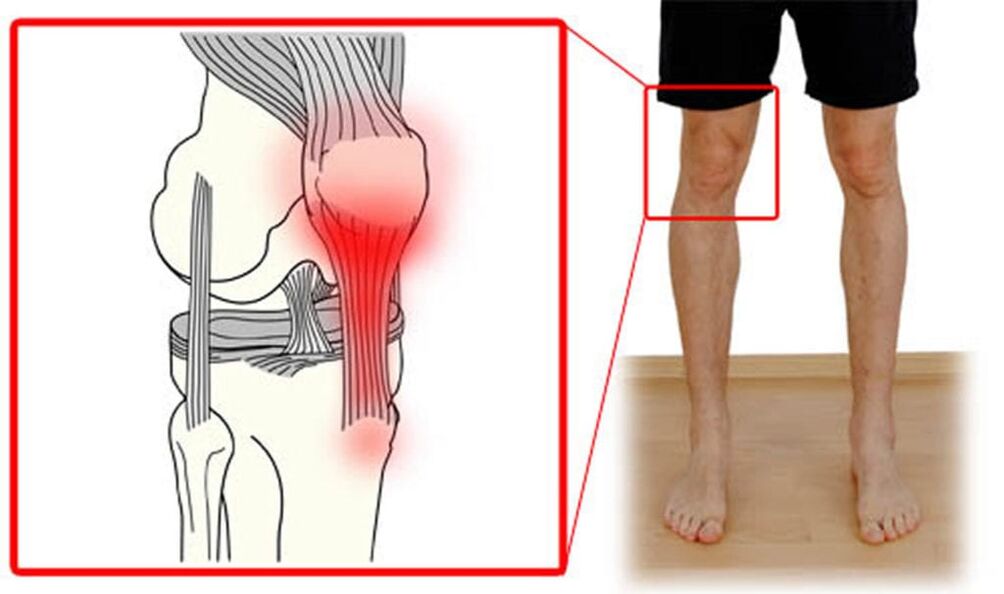 Tendonitis – upala tetiva u zglobu koljena