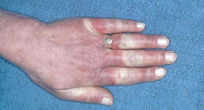 Klinička slika Raynaudovog sindroma - vazospazam, hiperemija, edem