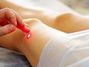 Liječenje artroze zgloba koljena laserom